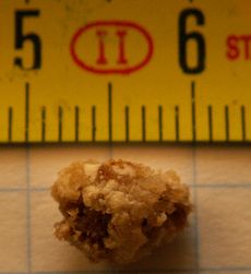 kidney-stone-8mm