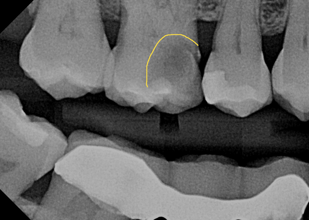 Cavity marked